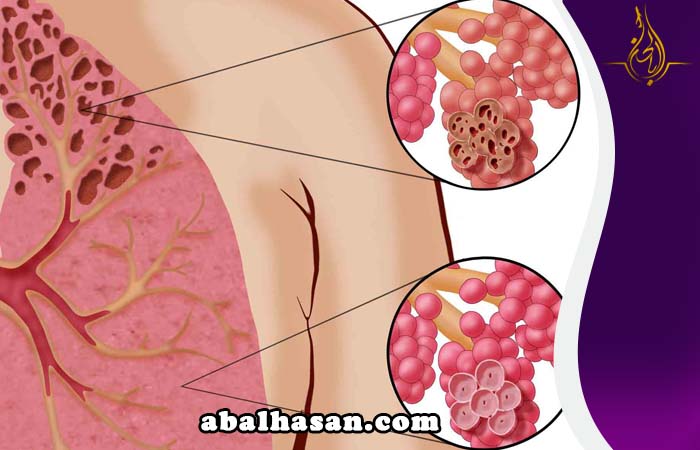 استئصال الكتلة السرطانية في إيران