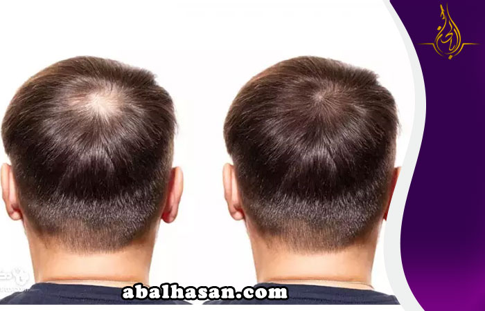 زراعة الشعر بيوفايبر في مصر