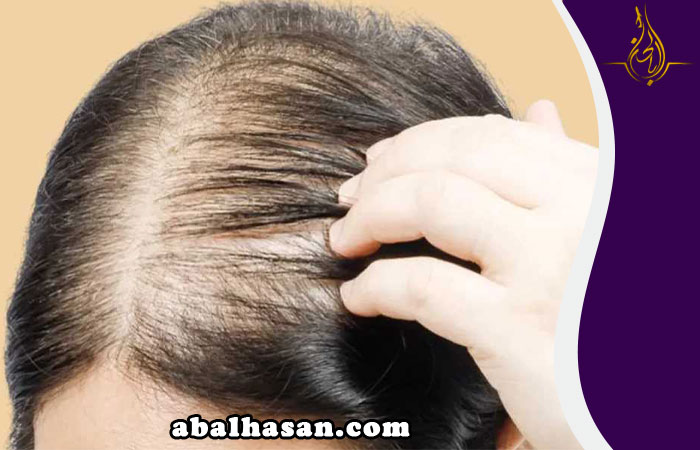 زراعة الشعر للنساء في مشهد